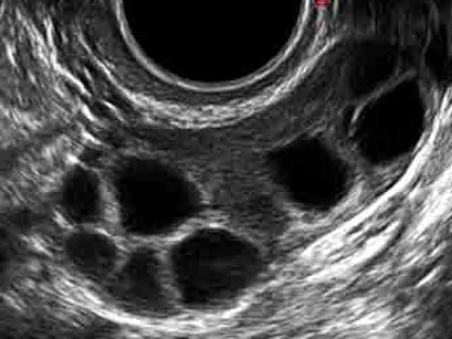 US of stimulated ovary (several follicles) - กุลพัฒน์การแพทย์ สหคลินิก 