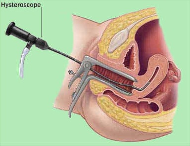 การส่งกล้องตรวจโพรงมดลูก (Hysteroscopy) - กุลพัฒน์การแพทย์ สหคลินิก