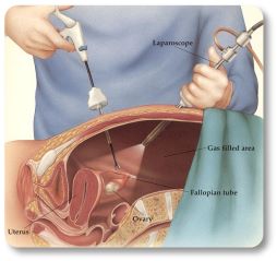 การผ่าตัดผ่านกล้องทางหน้าท้อง (Laparoscopy) - กุลพัฒน์การแพทย์ สหคลินิก